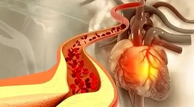 این ادویه دشمن سرسخت کلسترول خون است!