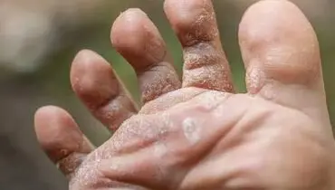 چرا پوست پا پوسته‌پوسته می‌شود؟ ۱۰ علت مهم را بشناسید