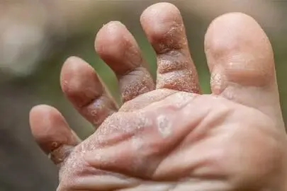 چرا پوست پا پوسته‌پوسته می‌شود؟ ۱۰ علت مهم را بشناسید