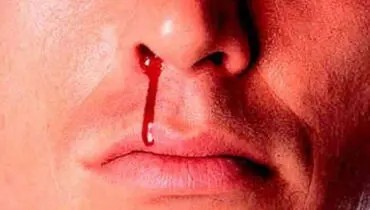 خون دماغ و ترشحات بینی در این شرایط خطرناک هستند
