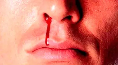 خون دماغ و ترشحات بینی در این شرایط خطرناک هستند
