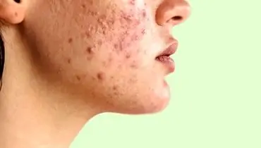 معجزه نوره برای رفع جوش‌های صورت؛ چطور مصرف کنیم؟