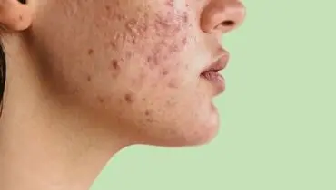 معجزه نوره برای رفع جوش‌های صورت؛ چطور مصرف کنیم؟
