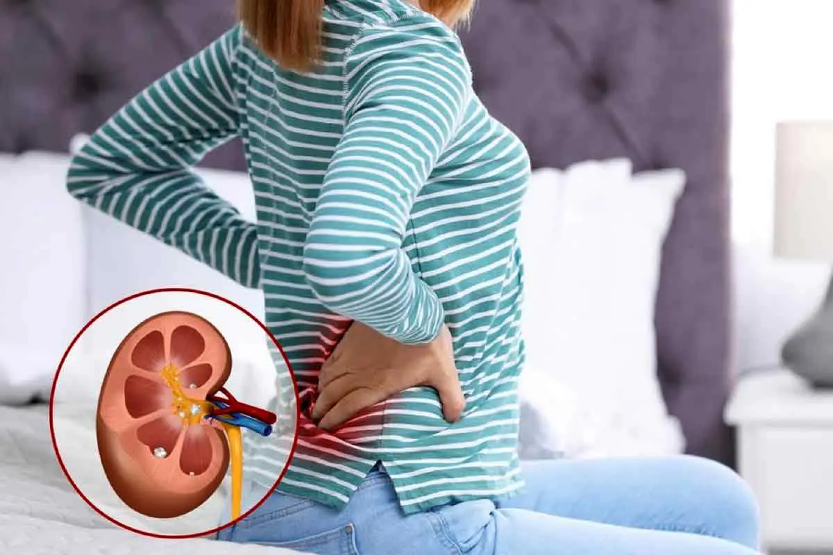 چگونه درد سنگ کلیه را آرام کنیم؟
