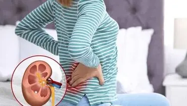 چگونه درد سنگ کلیه را آرام کنیم؟