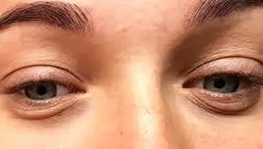 ارتباط پف زیر چشم و کبد: مکانیسم های پزشکی