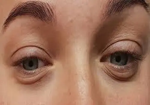 چند راهکار فوری برای رفع پف زیر چشم