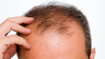 وداع با طاسی؛ کشف داروی جدید برای رفع طاسی مردانه