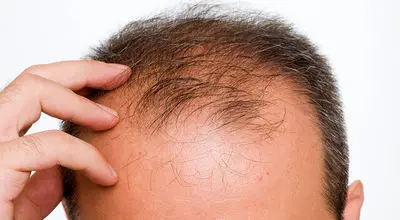 وداع با طاسی؛ کشف داروی جدید برای رفع طاسی مردانه