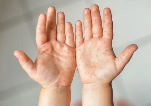 زنگ خطر به صدا درآمد ؛ آمار ابتلا به سرخک صعودی شد
