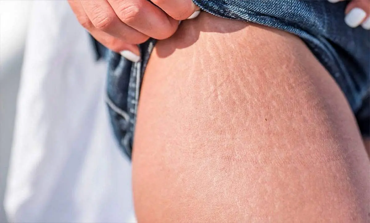 دلیل ترک خوردن پوست مان چیست؟