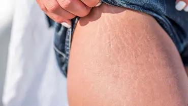 دلیل ترک خوردن پوست مان چیست؟