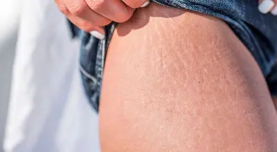 دلیل ترک خوردن پوست مان چیست؟