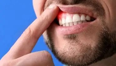 شایع ترین دلایل خونریزی از لثه