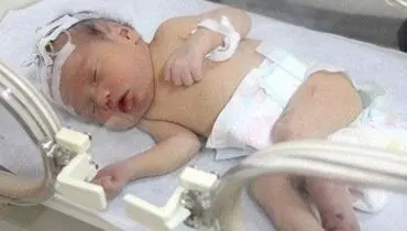 نوزاد ۵ ماهه بر اثر شکستن قلنج دچار قطع نخاع شد