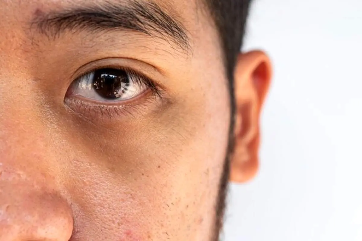 چه عواملی باعث تیرگی دور چشم میشوند؟