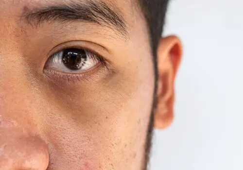 روش خانگی از بین بردن تیرگی دور چشم