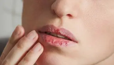 چگونه ترک لب را درمان کنیم؟