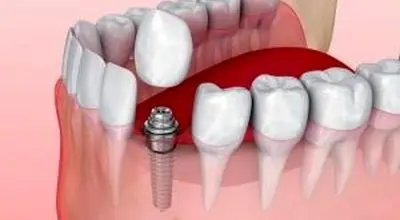 دلایل لق شدن ایمپلنت دندان ، چگونه درمان می شود ؟
