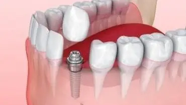 دلایل لق شدن ایمپلنت دندان ، چگونه درمان می شود ؟
