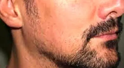 عوامل مؤثر بر رشد ریش
