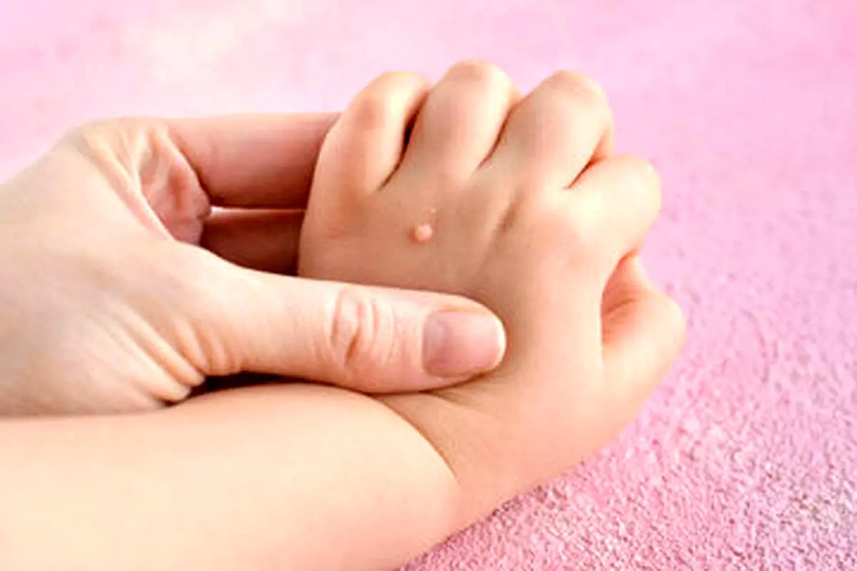 تفاوت خال گوشتی و زگیل چیست؟/ آیا کندن  زگیل با ناخنگیر یا بستن نخ خطرناک است؟
