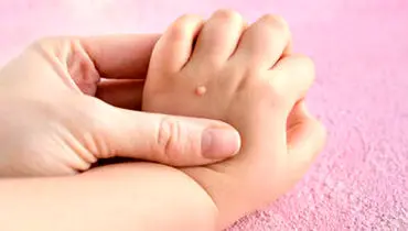 تفاوت خال گوشتی و زگیل چیست؟/ آیا کندن  زگیل با ناخنگیر یا بستن نخ خطرناک است؟
