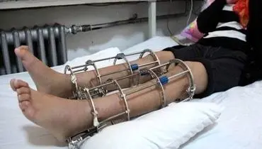 همه نکات مهم درباره جراحی افزایش قد