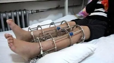 همه نکات مهم درباره جراحی افزایش قد