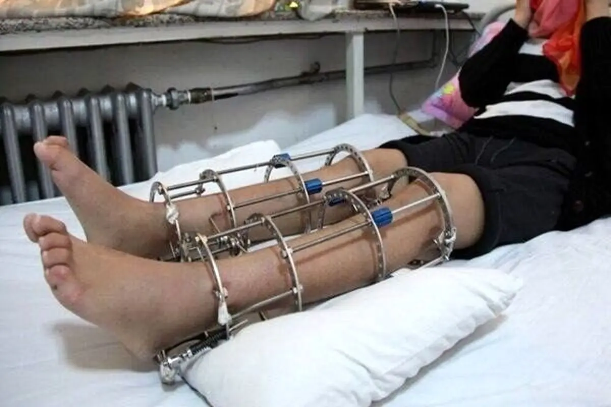 همه نکات مهم درباره جراحی افزایش قد
