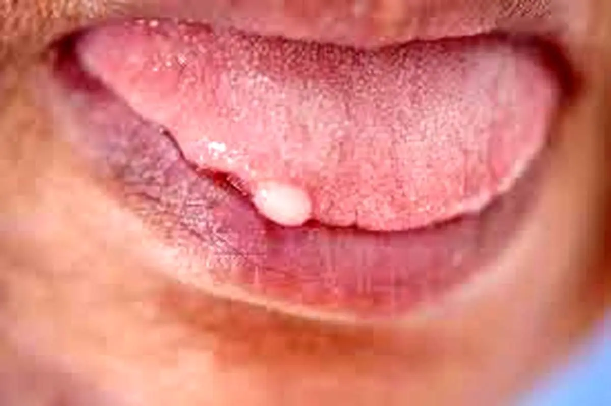 راهکار درمان زگیل زبان چیست؟ 