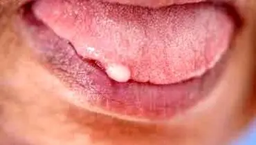راهکار درمان زگیل زبان چیست؟ 
