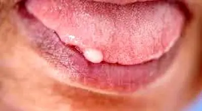 راهکار درمان زگیل زبان چیست؟ 