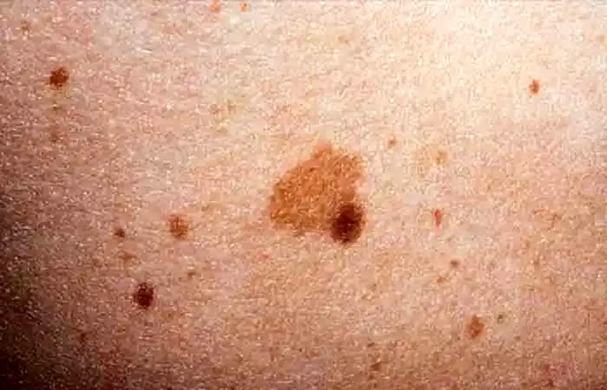 بهترین روش درمان لکه های قهوه ای بعد از لیزر