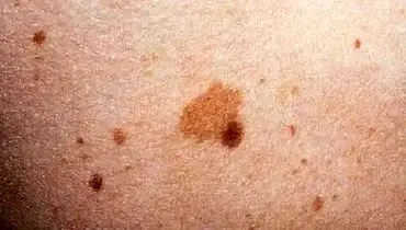 بهترین روش درمان لکه های قهوه ای بعد از لیزر