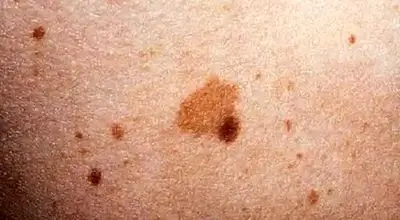 بهترین روش درمان لکه های قهوه ای بعد از لیزر