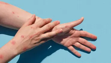 عوارض جدی بیماری‌ای به نام ابله مرغان