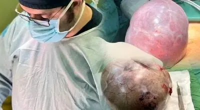 خارج کردن توده ۷ کیلویی از شکم بیمار آملی