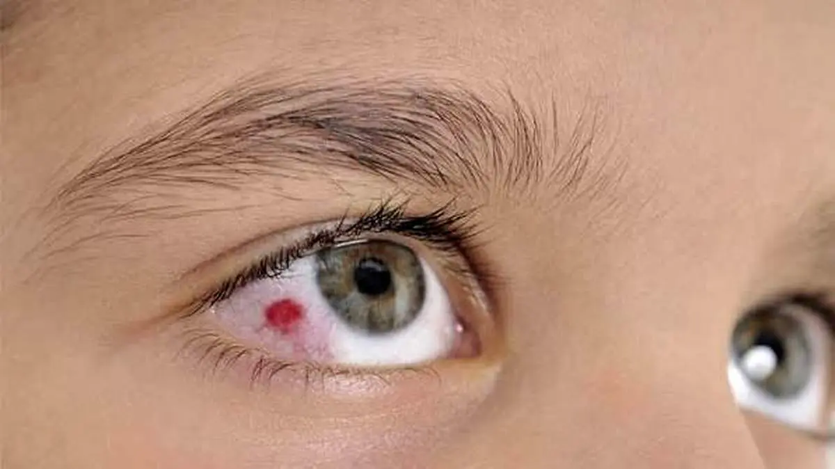 اقدامات فوری مراقیت از آسیب چشمی ناشی از انفجار 