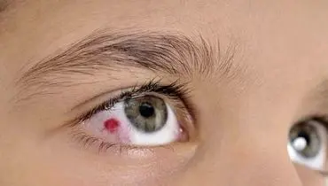 اقدامات فوری مراقیت از آسیب چشمی ناشی از انفجار 