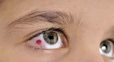 اقدامات فوری مراقیت از آسیب چشمی ناشی از انفجار 