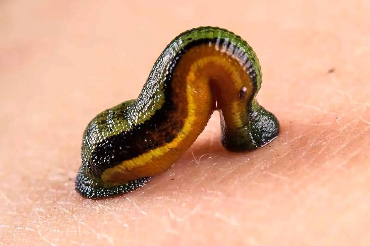 زالودرمانی؛ روش کم‌هزینه برای مدیریت پسوریازیس