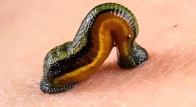 زالودرمانی؛ روش کم‌هزینه برای مدیریت پسوریازیس