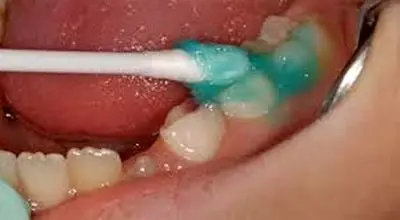 فلورایدتراپیِ دندانِ کودکان را از این سن شروع کنید 