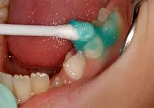 فلورایدتراپیِ دندانِ کودکان را از این سن شروع کنید 