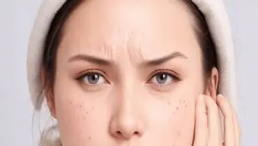 آیا پیتزا باعث جوش می‌شود؟ باورهای غلط درباره آکنه
