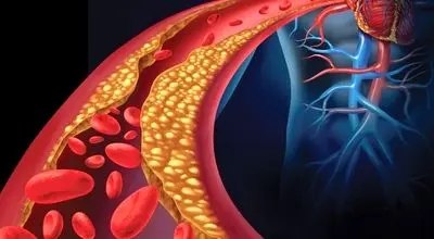 چربی خون بالا و غذاهایی که نباید خورد
