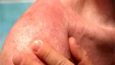 ژل سوختگی رادیوتراپی یا پرتو درمانی
