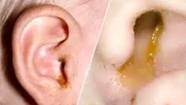 
هر آنچه که باید درباره مایع پشت پرده گوش بدانید!
