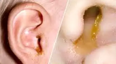 
هر آنچه که باید درباره مایع پشت پرده گوش بدانید!
